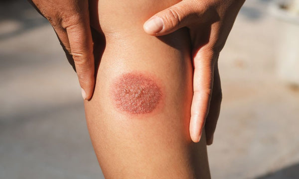 What Everyone Should Know About Burn Injuries